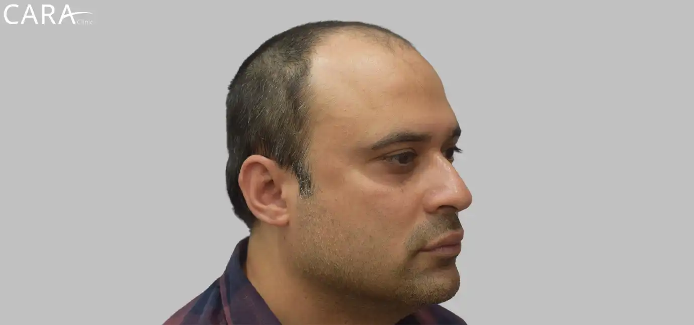 Before image of a hair transplant showing significant hair thinning and baldness in the front and mid-scalp areas.