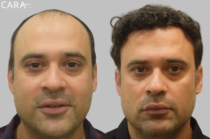 Male hair transplant showing before and after results, with restored hairline and increased hair density.