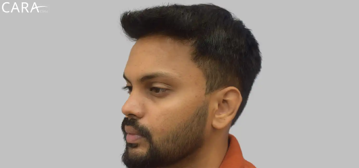 Ankit Jaiswal Hair Transplant After