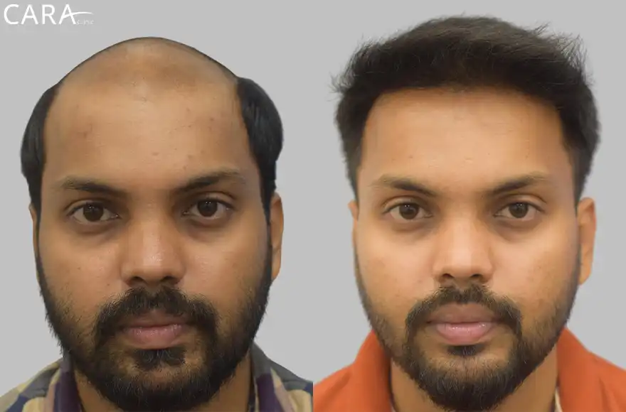 Male hair transplant showing before and after results, with restored hairline and increased hair density.