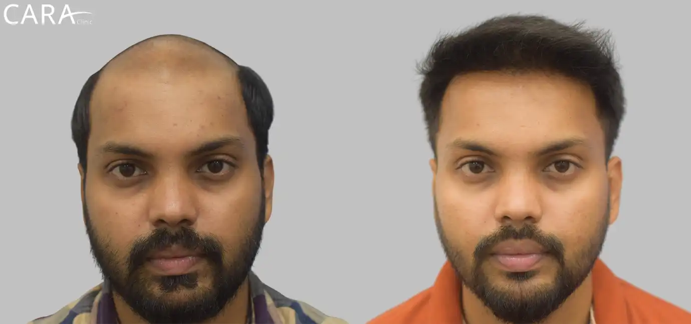 Ankit's Remarkable Hair Restoration: From Baldness to Fullness