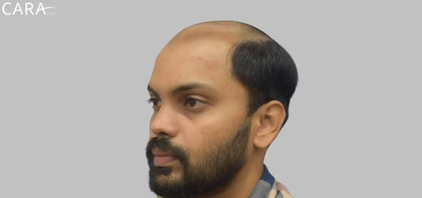 Ankit's Remarkable Hair Restoration: From Baldness to Fullness