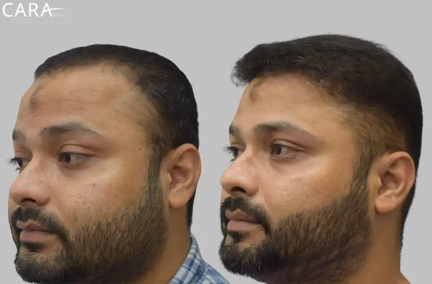 Male hair transplant showing before and after results, with restored hairline and increased hair density.