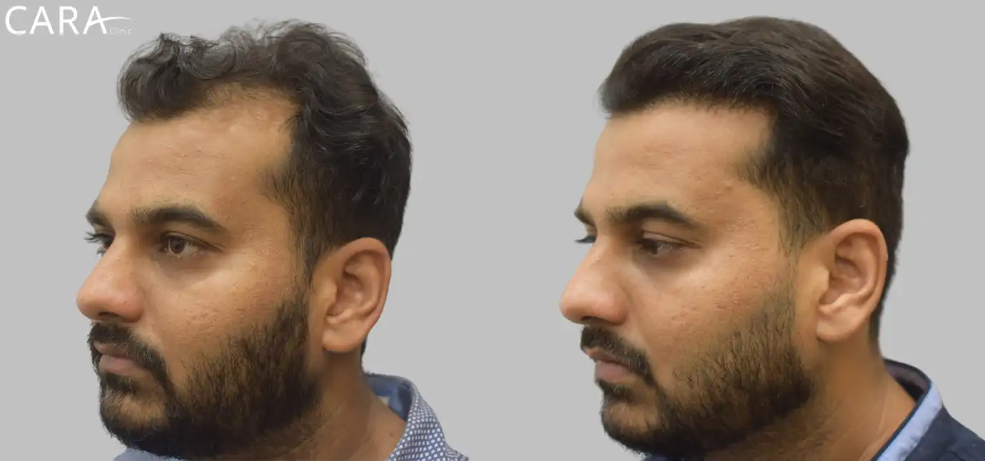 Male hair transplant showing before and after results, with restored hairline and increased hair density.