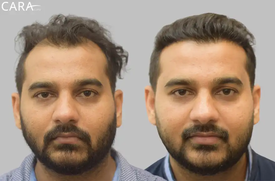 Male hair transplant showing before and after results, with restored hairline and increased hair density.