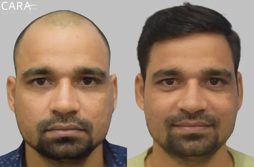 Male hair transplant showing before and after results, with restored hairline and increased hair density.