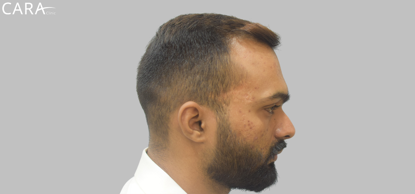 Before image of hairline transplant at Cara Clinic showing a receding hairline with uneven hair growth.