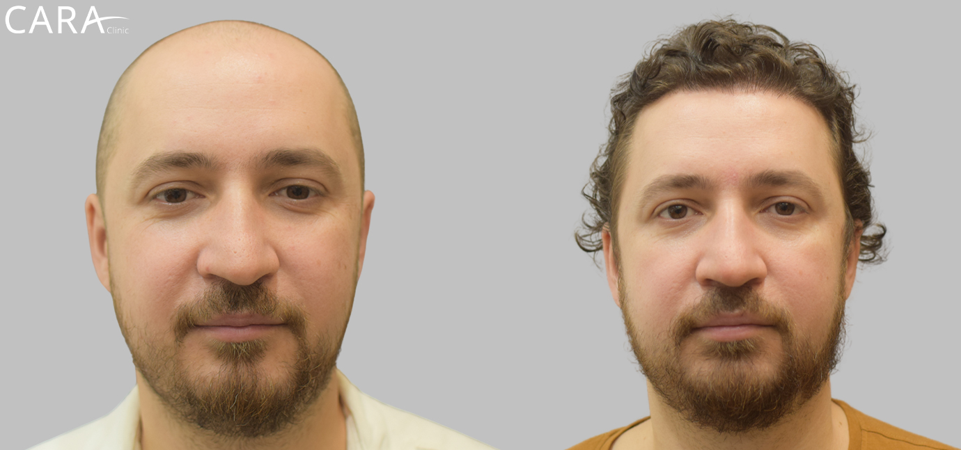 Before and after banner image of a FUE hair transplant showing clear improvement from hair thinning and baldness to a full, natural-looking hairline.