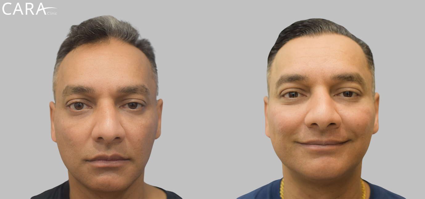 Before and after banner image of a FUE hair transplant showing clear improvement from hair thinning and baldness to a full, natural-looking hairline.