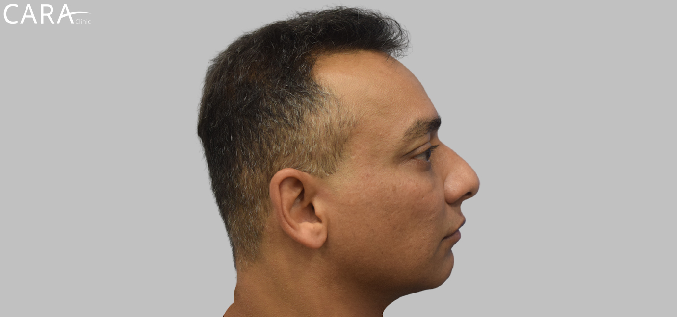 Before image of a FUE hair transplant patient showing thinning hair and bald spots in the front and crown.