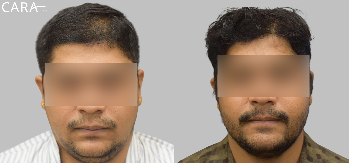 Before and after images of a beard hair transplant showing significant improvement in facial hair density, with a fuller and more even beard appearance.