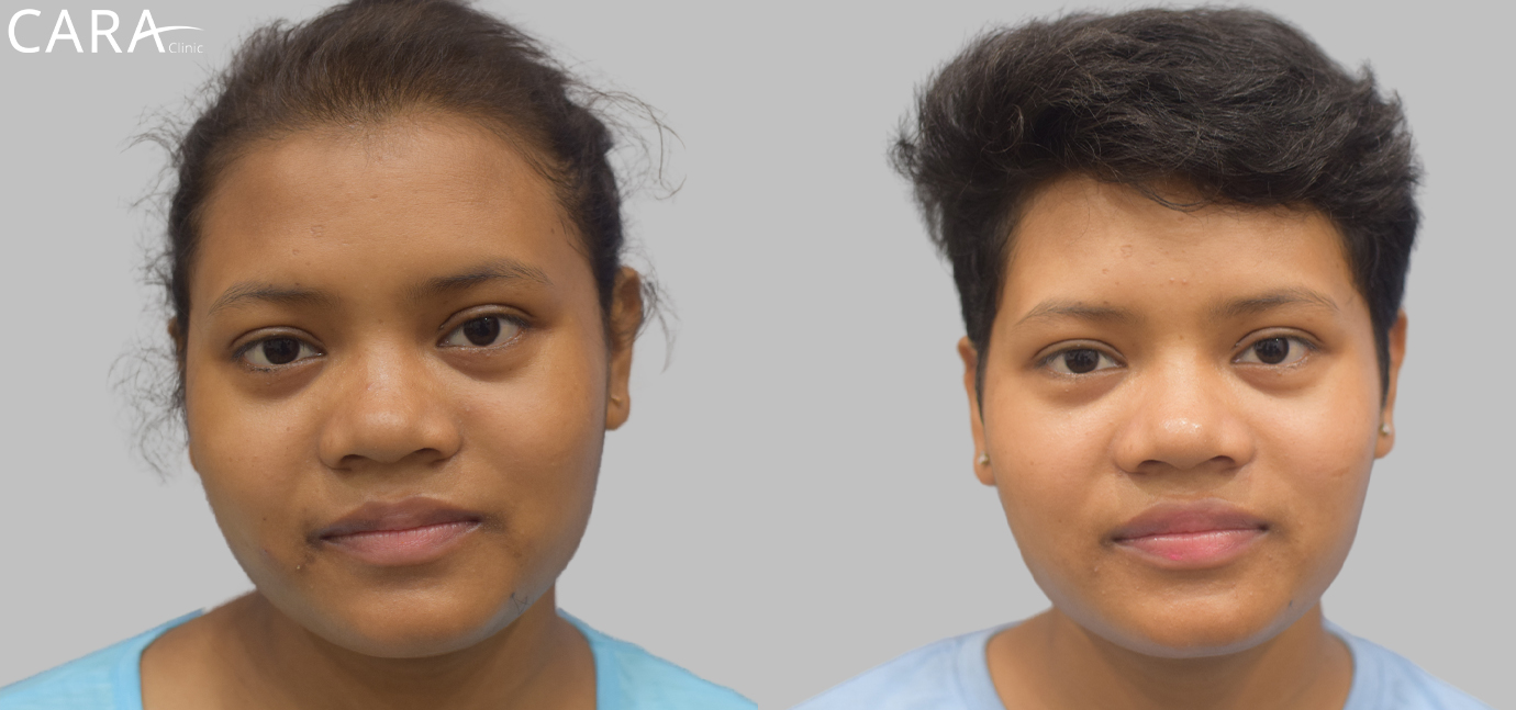 Banner showcasing the transformation of female hair loss treatment at Cara Clinic, featuring a before image with thinning hair and an after image with restored volume and density