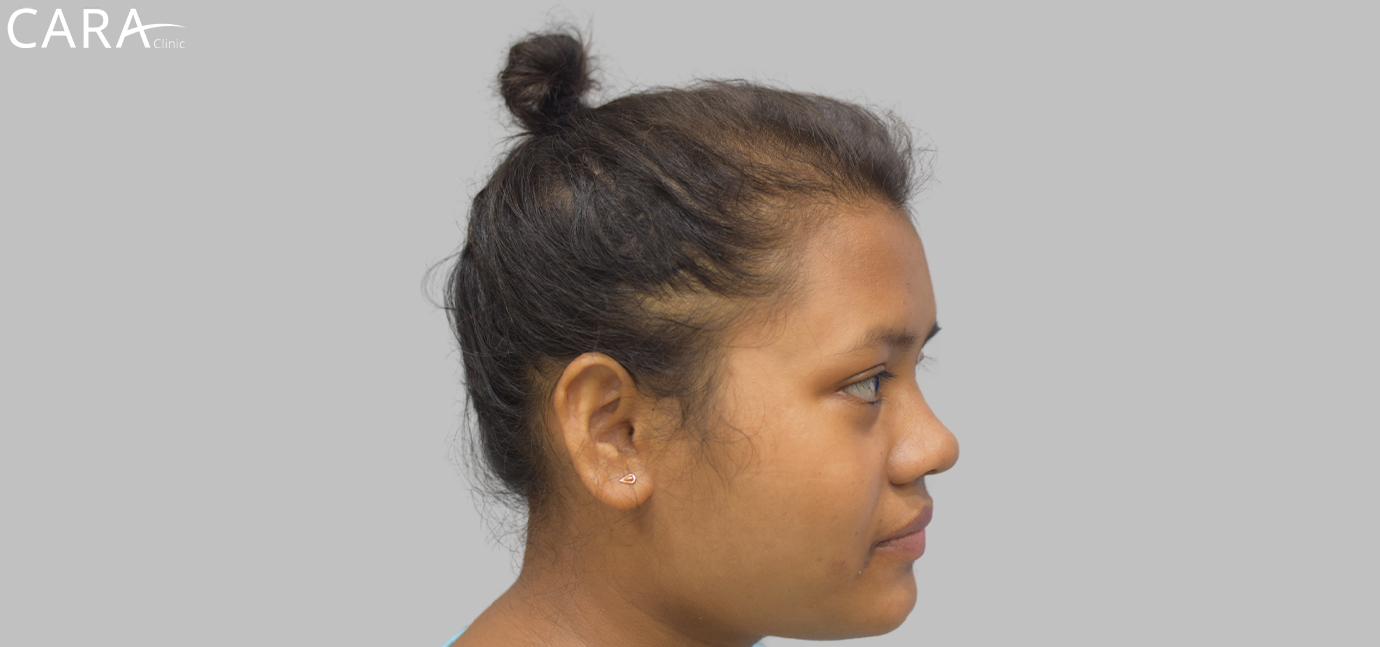 Before female hair loss treatment at Cara Clinic showing visible hair thinning and scalp exposure.