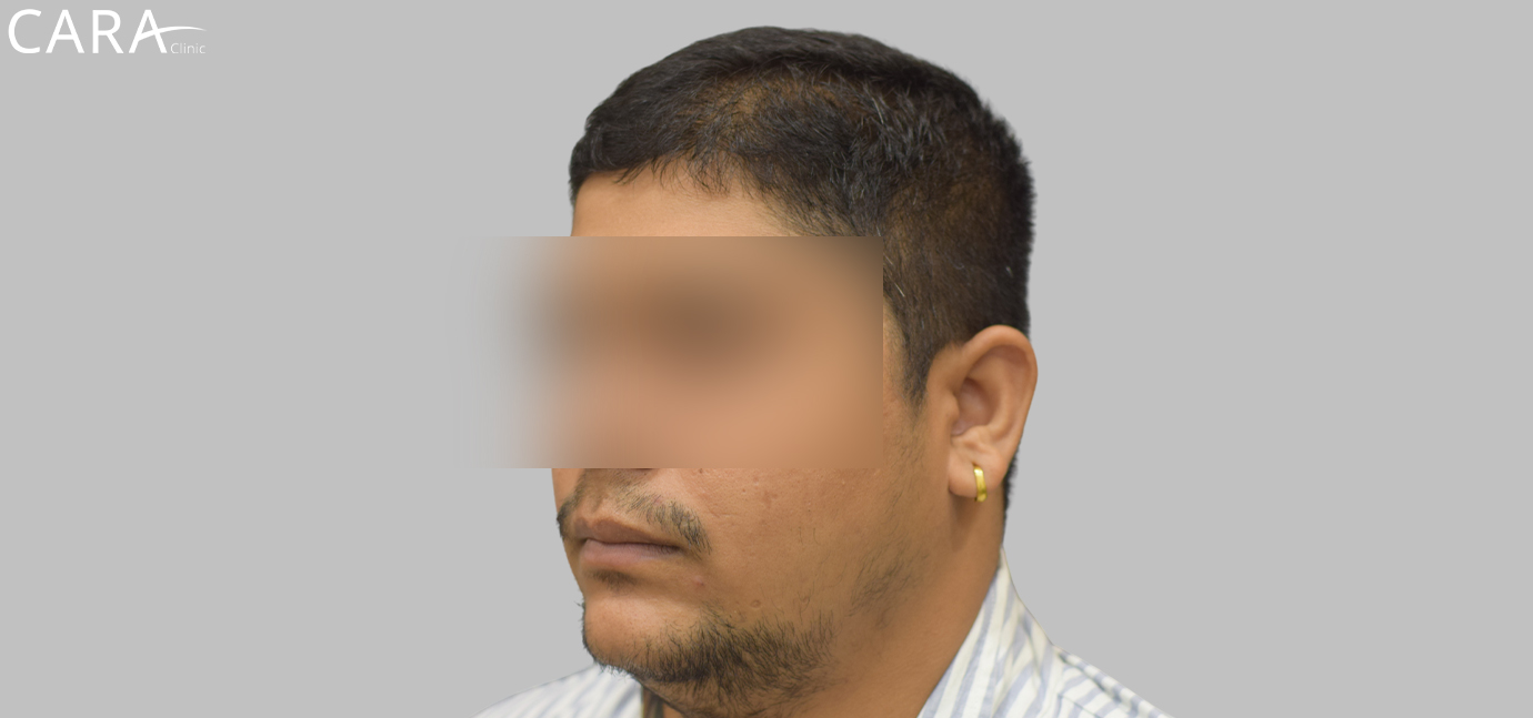 Before image of a beard hair transplant showing patchy and uneven facial hair growth.