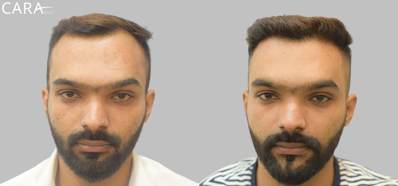 Banner displaying the results of a hairline transplant at Cara Clinic, featuring a before image with a receding hairline and an after image showcasing a defined, natural-looking hairline restoration.