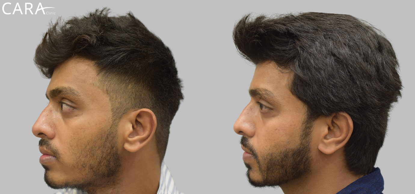 Before and after images of a beard hair transplant showing significant improvement in facial hair density, with a fuller and more even beard appearance.