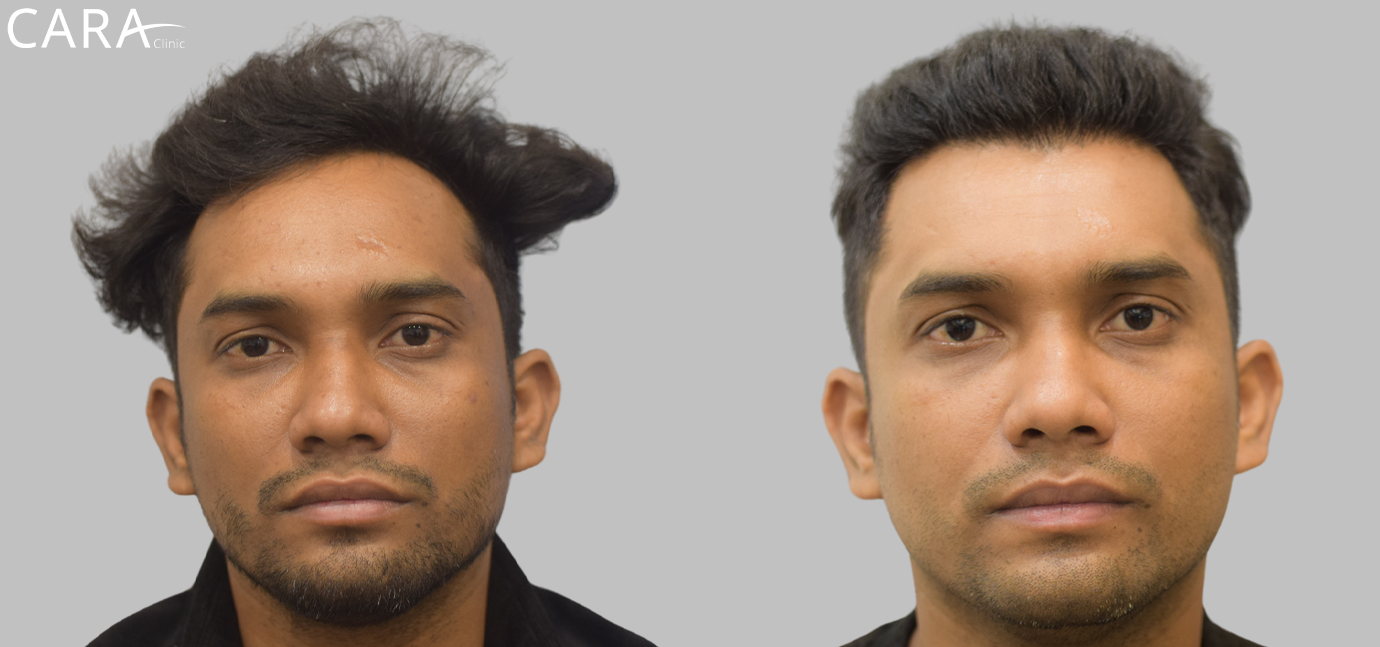 Before and after results of hairline transplant showing natural hair growth restoration using advanced FUE technique at Cara Clinic.