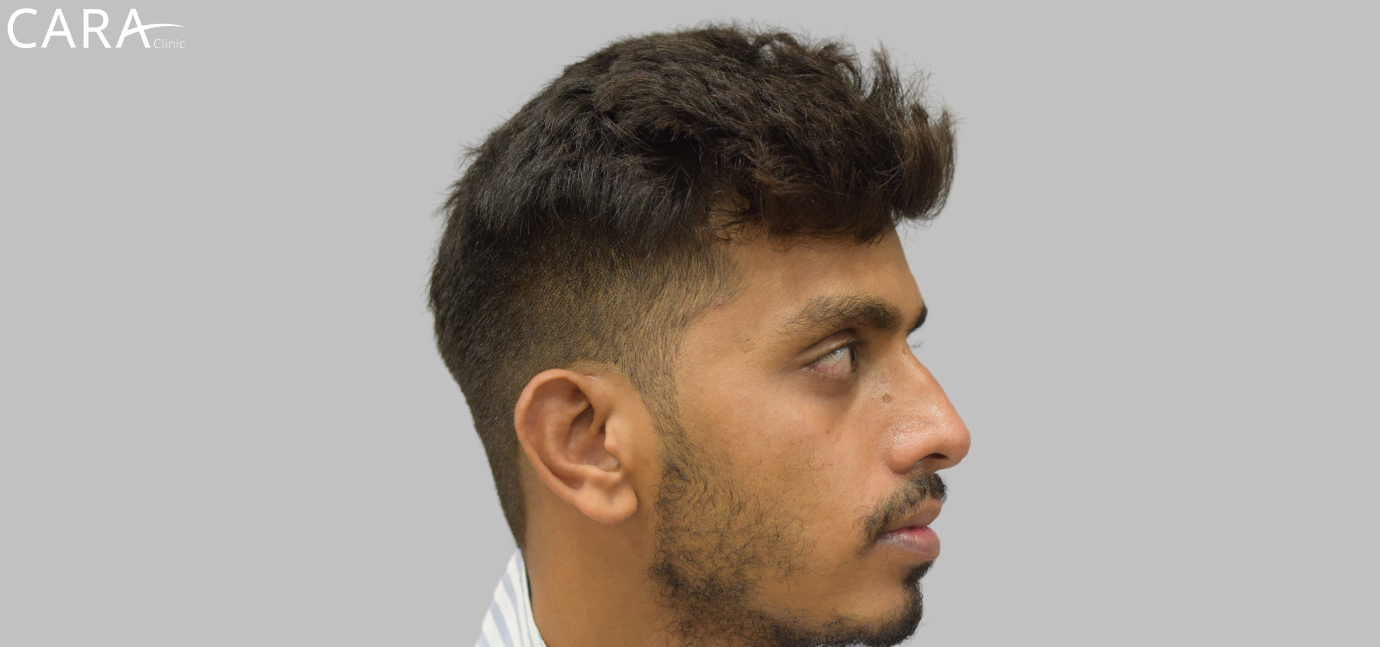 Before image of a beard hair transplant showing patchy and uneven facial hair growth.