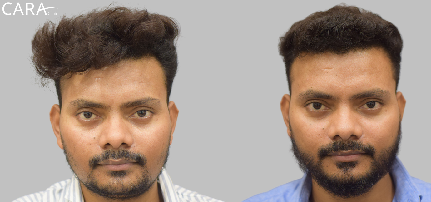 Before and after images of a beard hair transplant showing a noticeable increase in facial hair thickness, resulting in a fuller and more evenly shaped beard.