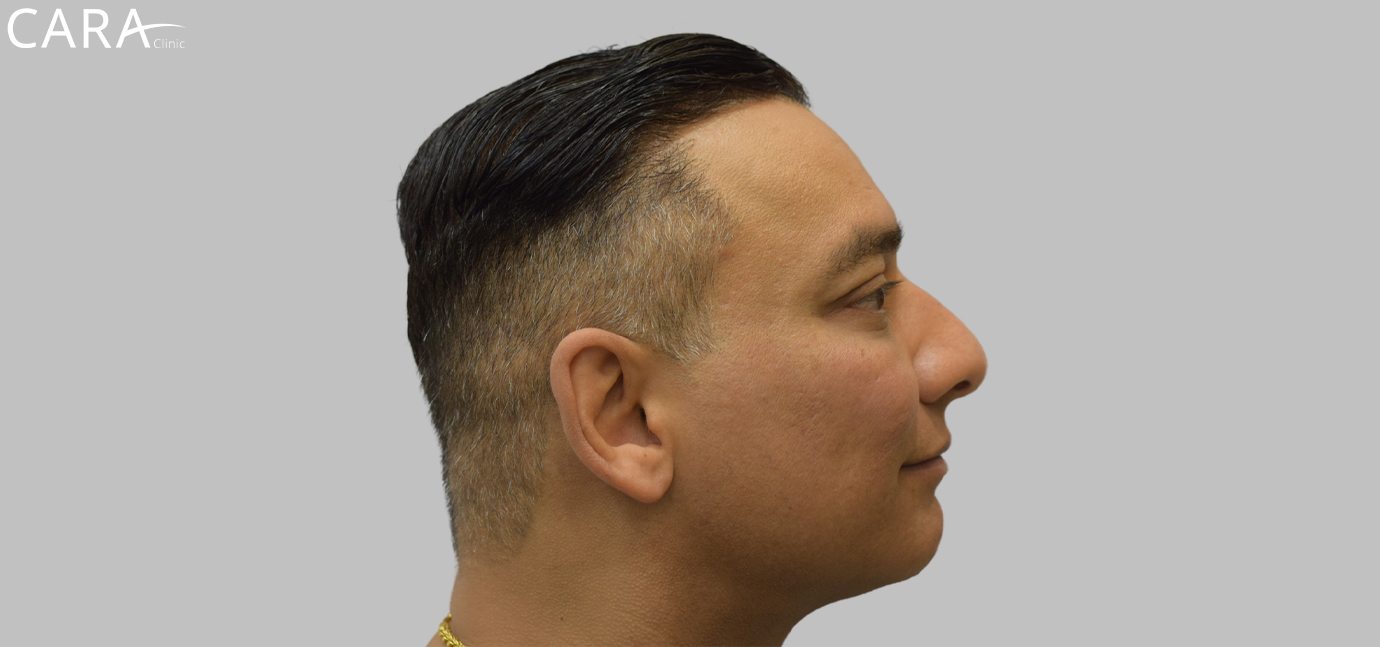 After image of a FUE hair transplant patient showing a natural-looking hairline with thicker, fuller hair.