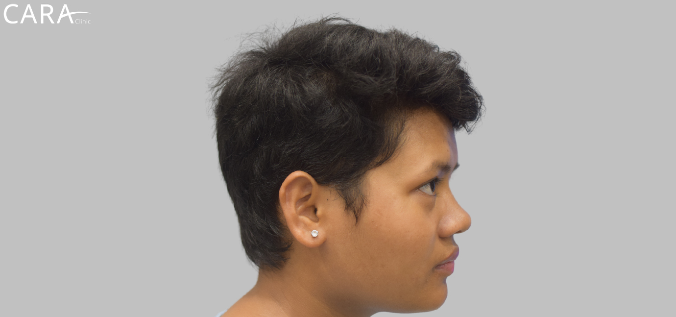 After female hair loss treatment at Cara Clinic highlighting restored hair volume, density, and a fuller appearance.