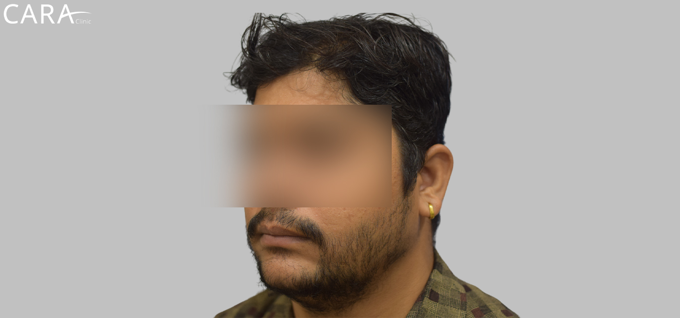 After image of a beard hair transplant showing a fuller, even, and natural-looking beard.