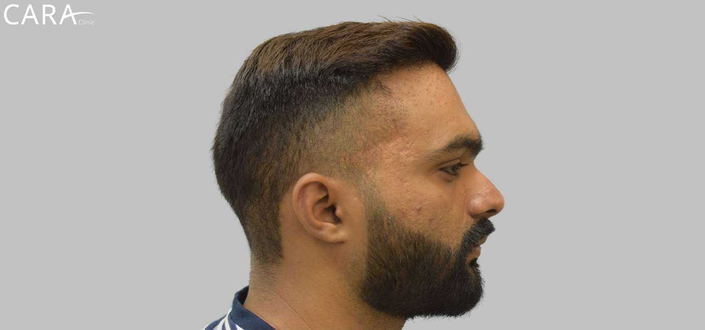 After image of hairline transplant at Cara Clinic showcasing a restored, natural-looking hairline with improved density.