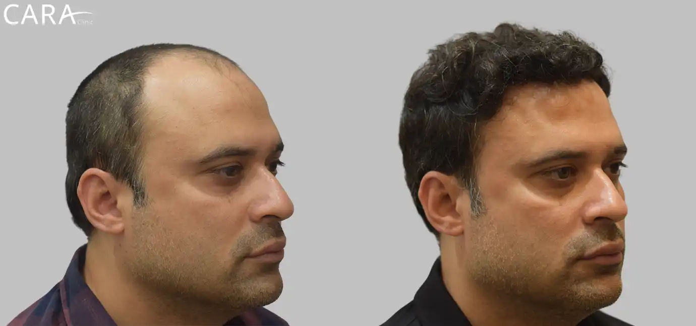 Before and after images of a hair transplant patient showing a restored natural hairline and improved hair density.