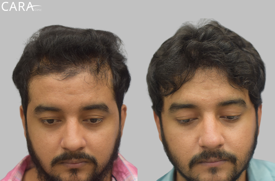 This is the banner image for Hairline Transplant treatment, showing a natural-looking restored hairline