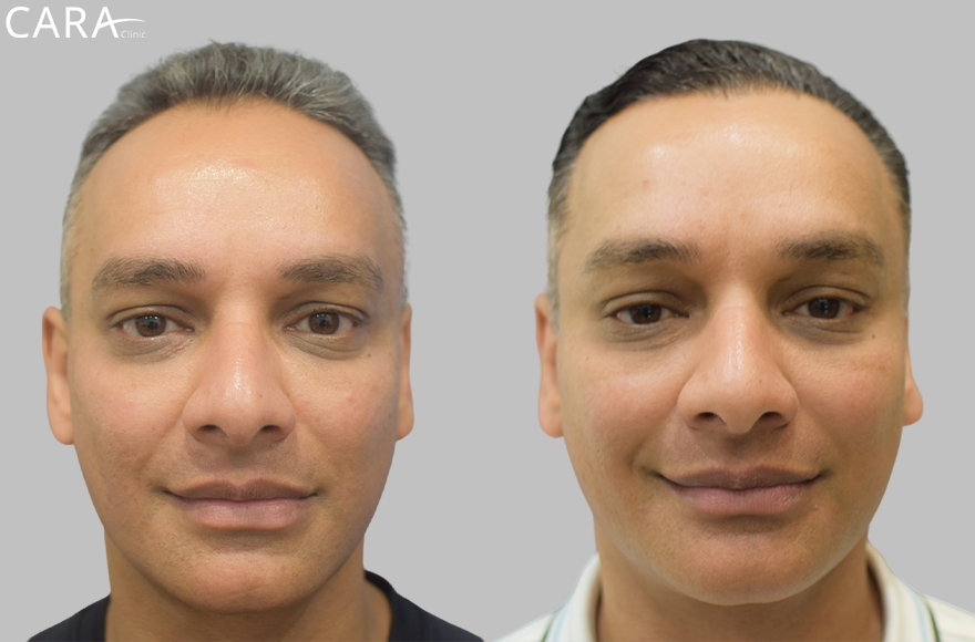 Before and after banner image of a FUE hair transplant showing clear improvement from hair thinning and baldness to a full, natural-looking hairline.