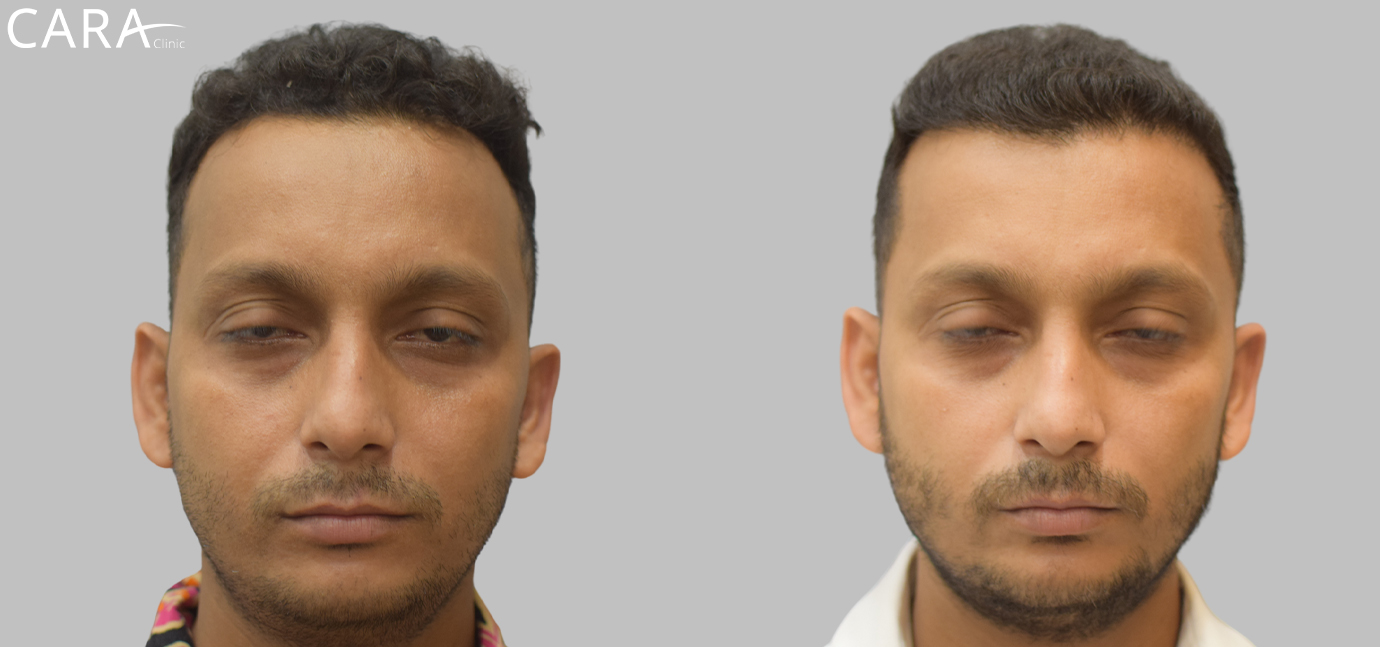 Before and after results of hairline transplant showing natural hair growth restoration using advanced FUE technique at Cara Clinic.