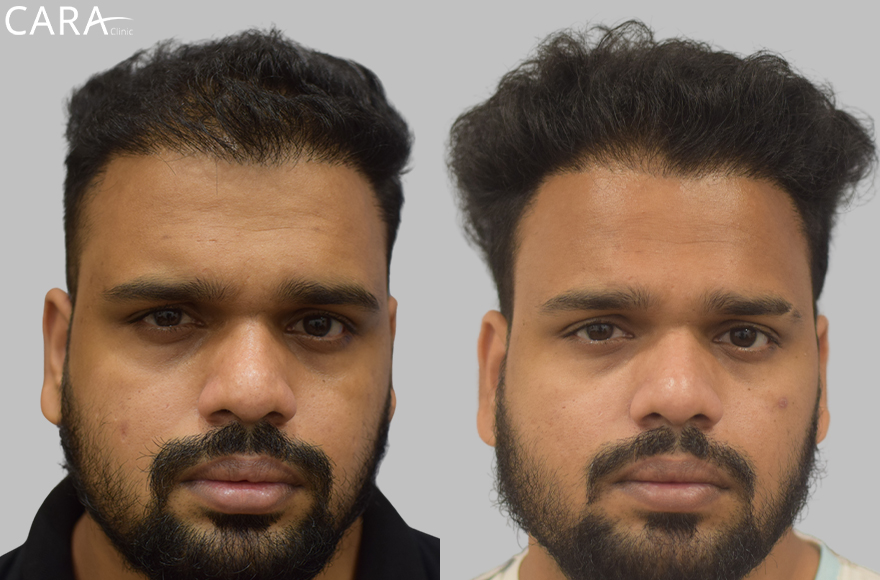 before and after image of male hair loss treatments