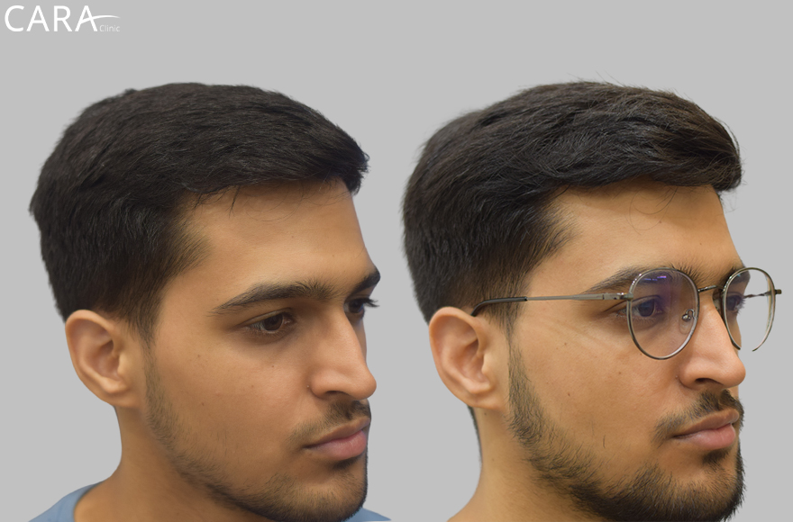 before and after image of male hair loss treatments