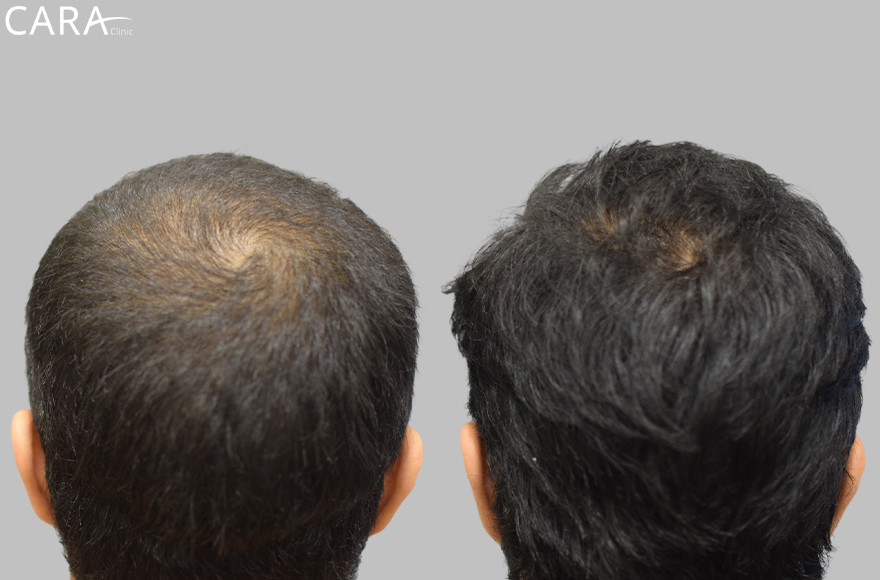 before and after image of male hair loss treatments