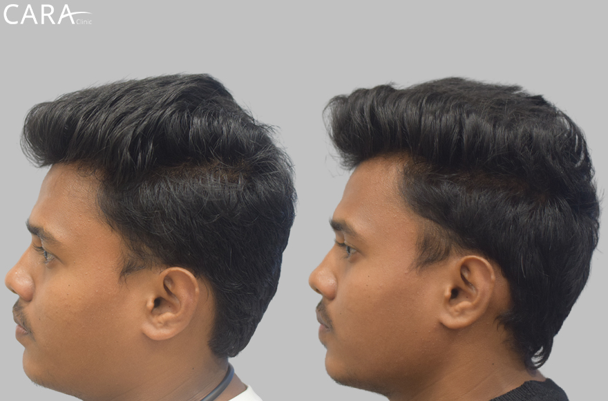 before and after image of male hair loss treatments