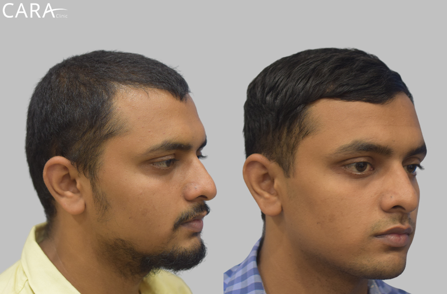 before and after image of male hair loss treatments