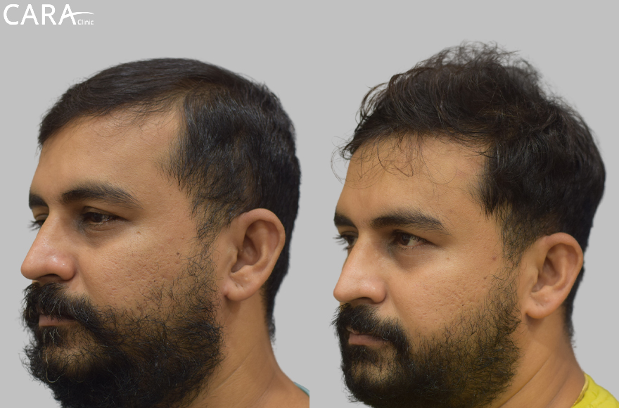 before and after image of male hair loss treatments