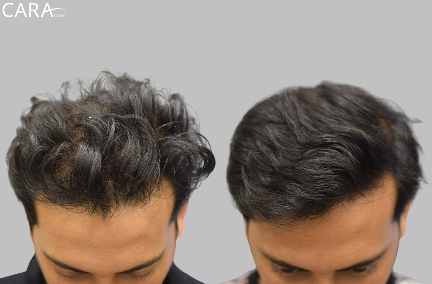 before and after image of male hair loss treatments