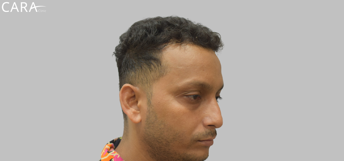 Patient with receding hairline before hairline transplant procedure at Cara Clinic.