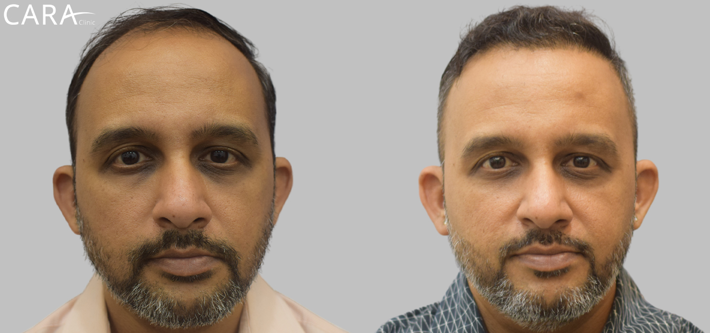 Banner displaying the results of a hair transplant at Cara Clinic, featuring a before image with a receding hairline and an after image showcasing a defined, natural-looking hairline restoration.