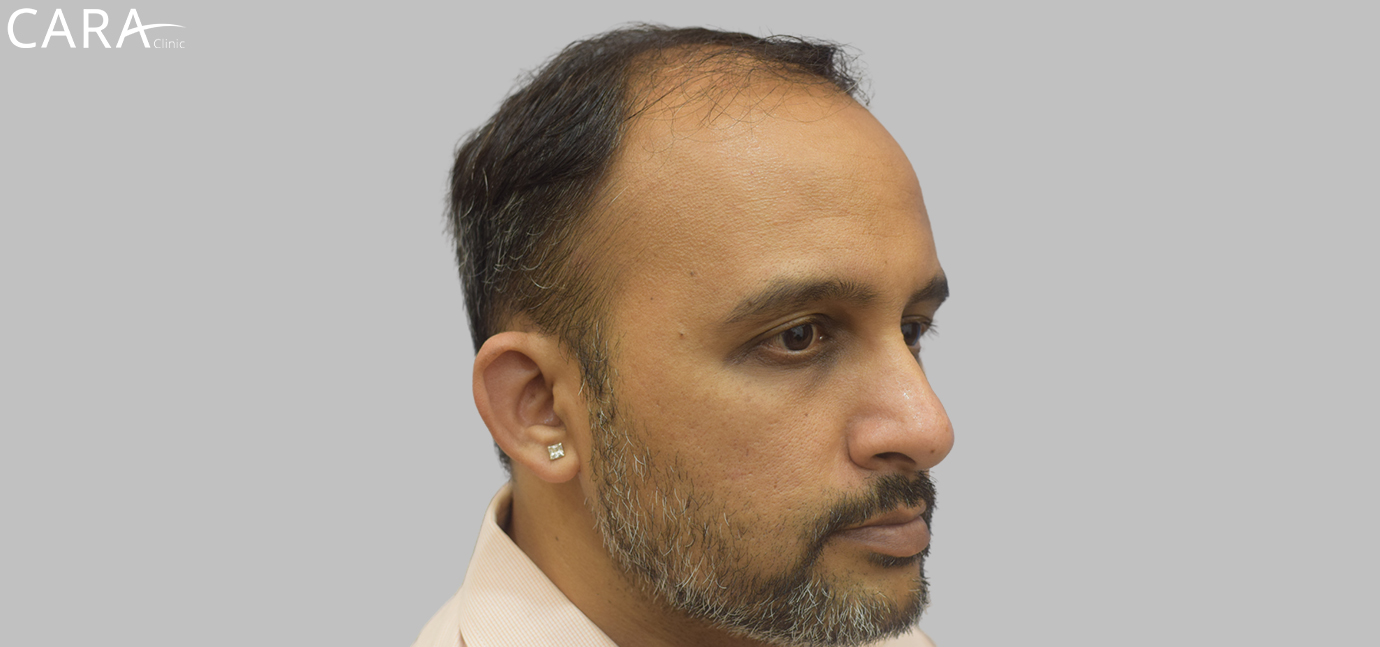 Before image of male hair transplant at Cara Clinic showing visible hair thinning and receding hairline.