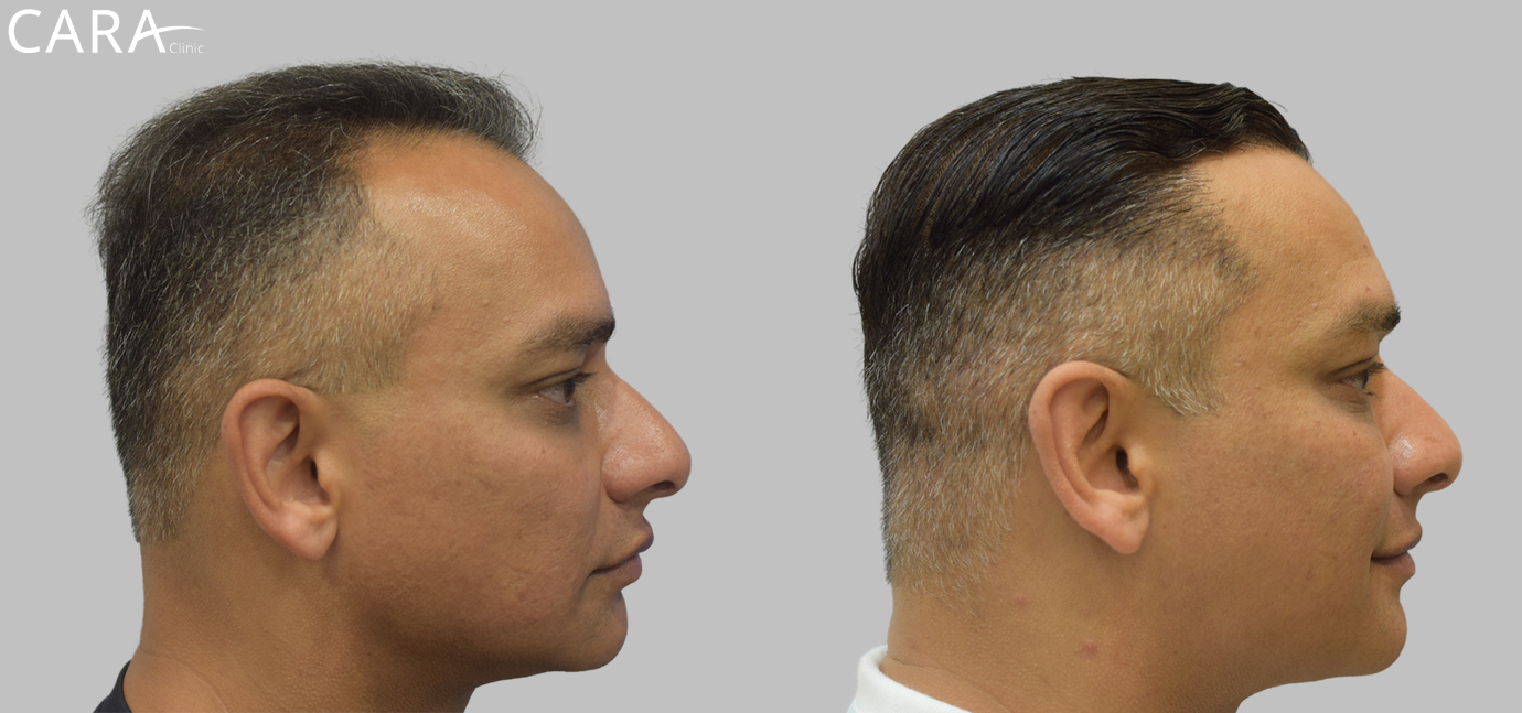 Before and after banner image of a FUE hair transplant showing clear improvement from hair thinning and baldness to a full, natural-looking hairline.