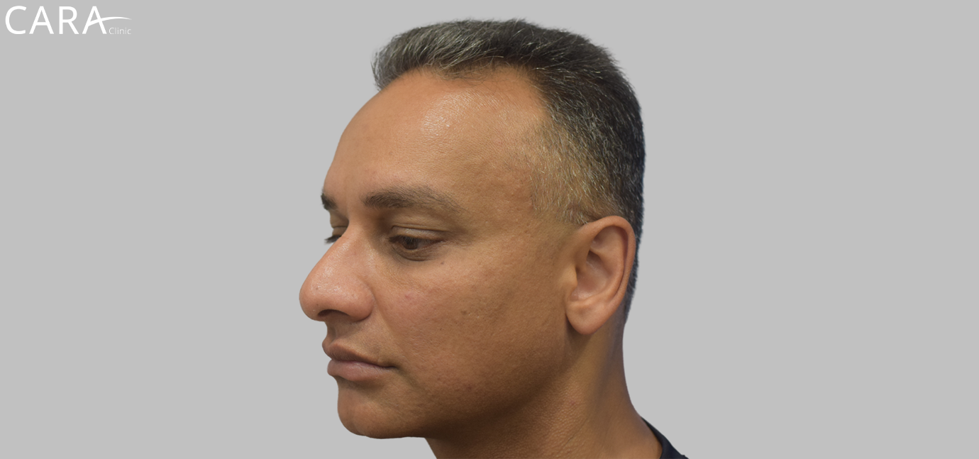 Before image of a FUE hair transplant patient showing thinning hair and bald spots in the front and crown.