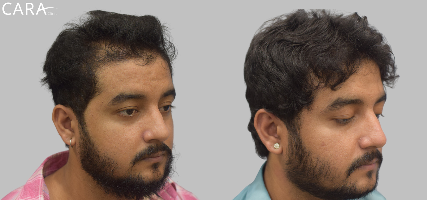 Before and after results of hairline transplant showing natural hair growth restoration using advanced FUE technique at Cara Clinic.