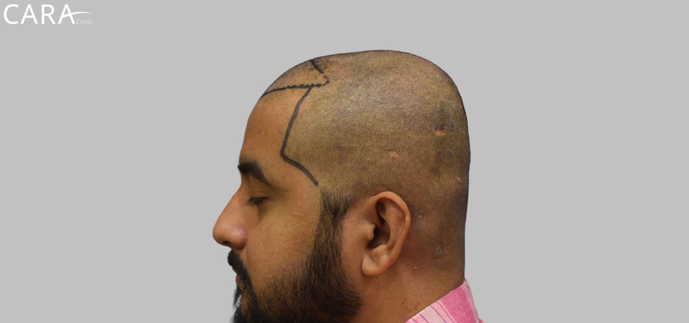 Patient with receding hairline before hairline transplant procedure at Cara Clinic.