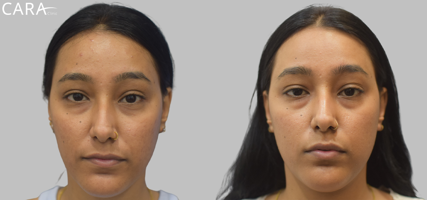 Side-by-side comparison showcasing the transformation in a patient's skin after acne and acne scar treatment. The 'before' image reveals acne scars and uneven skin texture, while the 'after' image shows smoother, clearer skin with significantly reduced scarring.