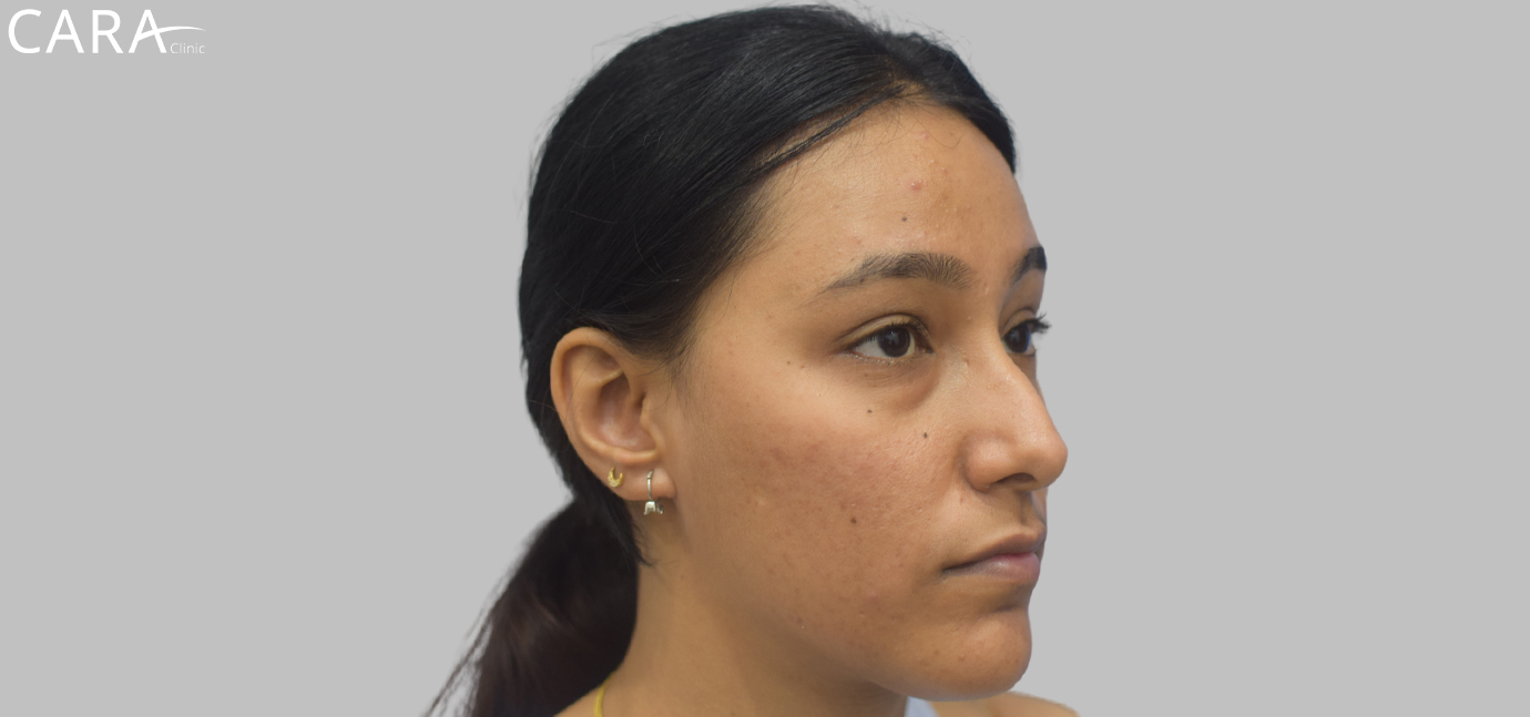 Close-up of the patient's skin before treatment, highlighting visible acne scars, active breakouts, and uneven skin texture primarily on the cheeks and jawline.