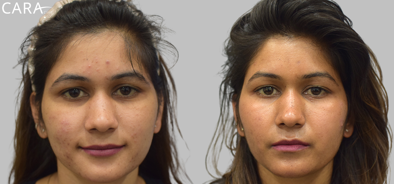 Side-by-side comparison showcasing the transformation in a patient's skin after acne and acne scar treatment. The 'before' image reveals acne scars and uneven skin texture, while the 'after' image shows smoother, clearer skin with significantly reduced scarring.