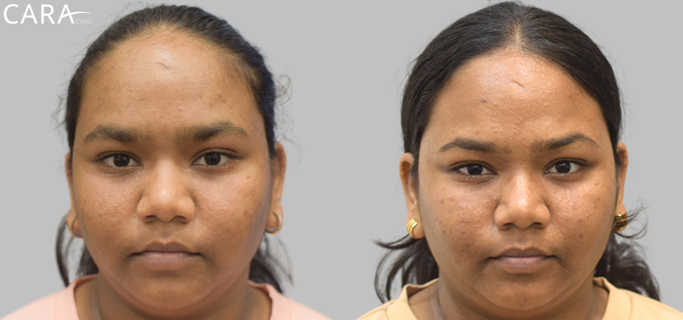 Side-by-side comparison showcasing the transformation in a patient's skin after acne and acne scar treatment. The 'before' image reveals acne scars and uneven skin texture, while the 'after' image shows smoother, clearer skin with significantly reduced scarring.