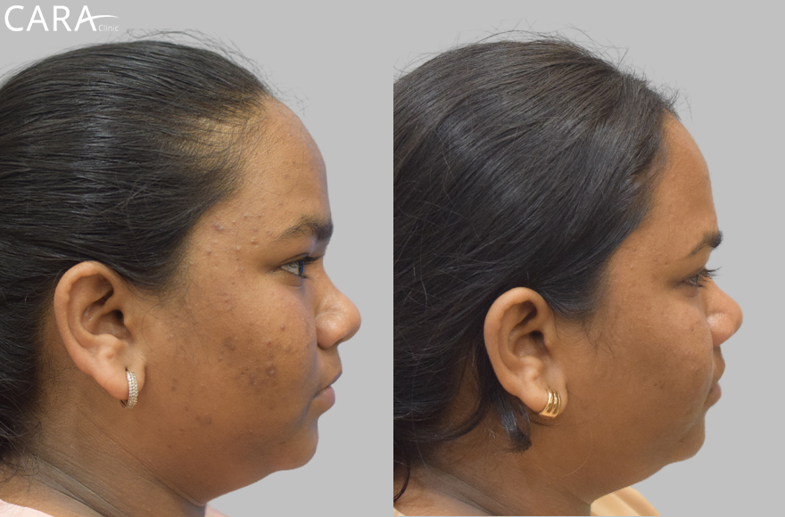 before and after image of female acne and scar treatment image